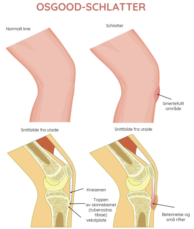 SCHLATTER SYKDOM: Knesmerter som rammer mange barn og ungdommer. Foto: NTB Scanpix/Shutterstock. Norsk tekst ved Lommelegen.no SCHLATTER SYKDOM: Knesmerter som rammer mange barn og ungdommer. Foto: NTB Scanpix/Shutterstock. Norsk tekst ved Lommelegen.no